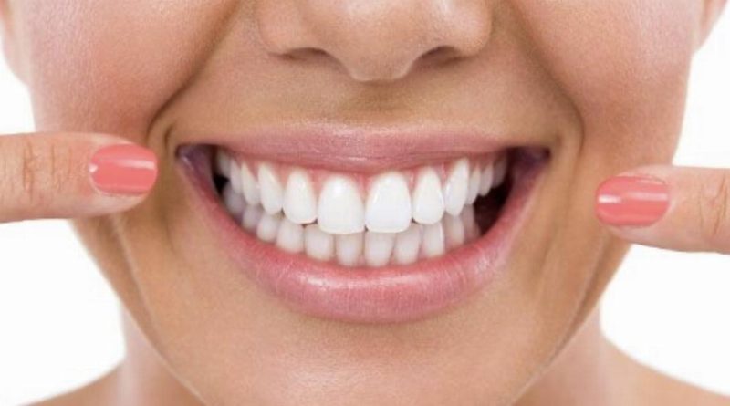 Come migliorare esteticamente il proprio sorriso 15