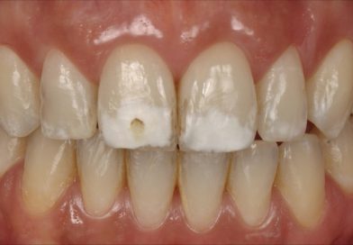 Fluorosi Dentale: Come curare le macchie bianche sui denti?