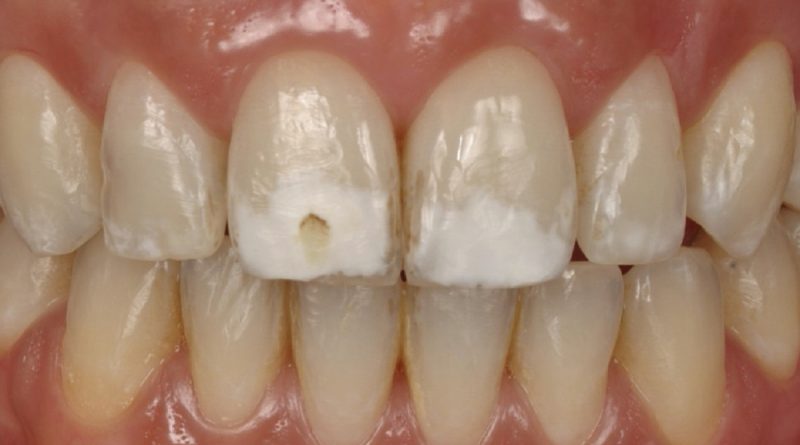 Fluorosi Dentale: Come curare le macchie bianche sui denti? 7